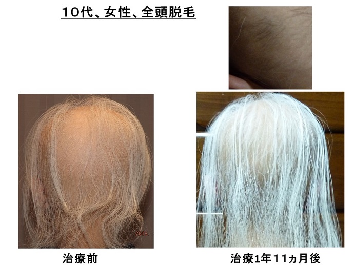 円形脱毛症　病院